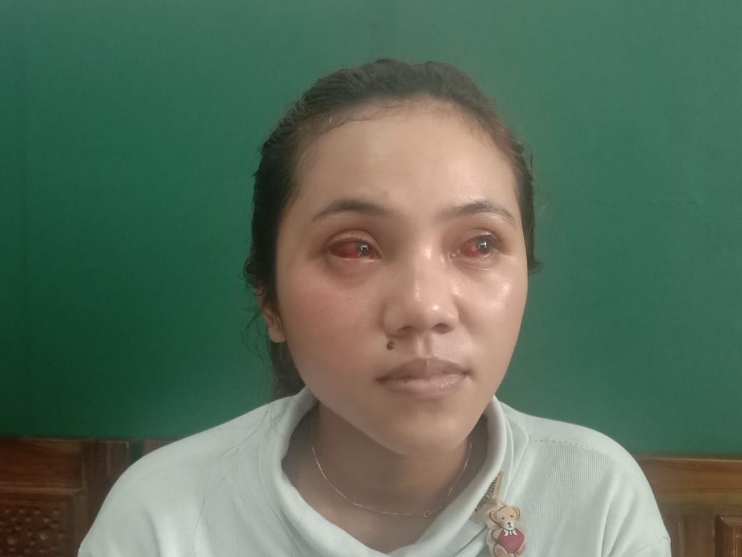 Kevia Naswa, salah satu korban tragedi Kanjuruhan yang mata merahnya dan luka kakinya belum pulih.