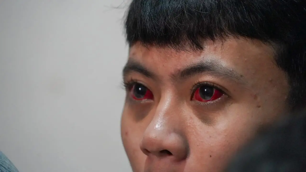 Mata korban tragedi Kanjuruhan merah darah.