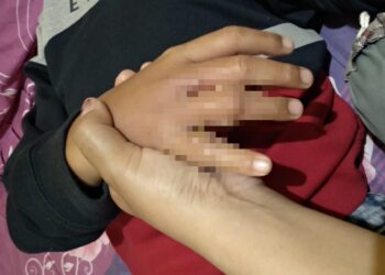 Kondisi jari tangan anak di Malang yang bengkak akibat terlalu sering main Latto latto.