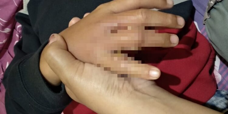 Kondisi jari tangan anak di Malang yang bengkak akibat terlalu sering main Latto latto.