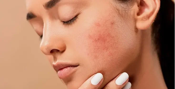 Ilustrasi penggunaan skincare yang gagal. Foto/Pinterest