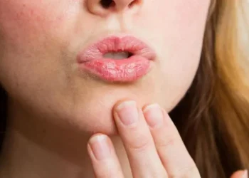 Ilustrasi bibir kering saat berpuasa dan cara mengatasinya. (Foto: Pinterest)
