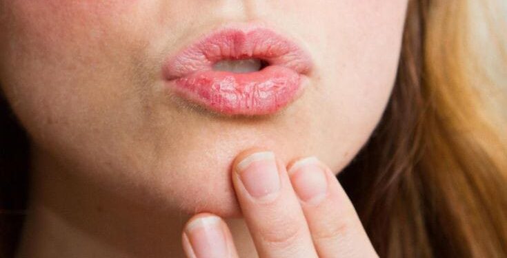 Ilustrasi bibir kering saat berpuasa dan cara mengatasinya. (Foto: Pinterest)