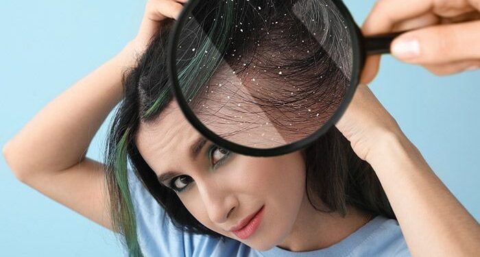 Ilustrasi jenis Ketombe di kepala. Foto/Pinterst