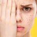 Cacar air bisa menimbulkan ketidaknyamanan yang cukup besar, namun jika segera mengatasi gejalanya tubuh bisa pulih lebih cepat. Foto: Pinterest