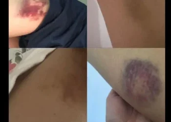 Luka luka diduga bekas kekerasan mahasiswa Binus Malang. (Foto/Akun X @atalaricc)