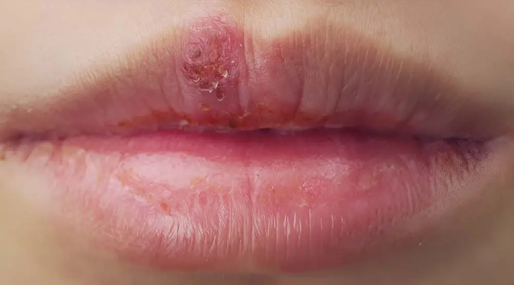 Bibir pecah akibat sariawan