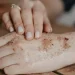 PHM ungkap masalah gatal setelah mandi bukan masalah salah sabun tapi karena kulit sensitif, produk herbal Sativa Cream jadi solusi. /Foto: Unsplash.com/Anita Austvika.
