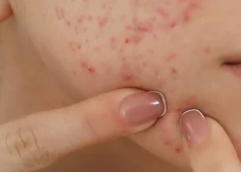 Masih ada jerawat